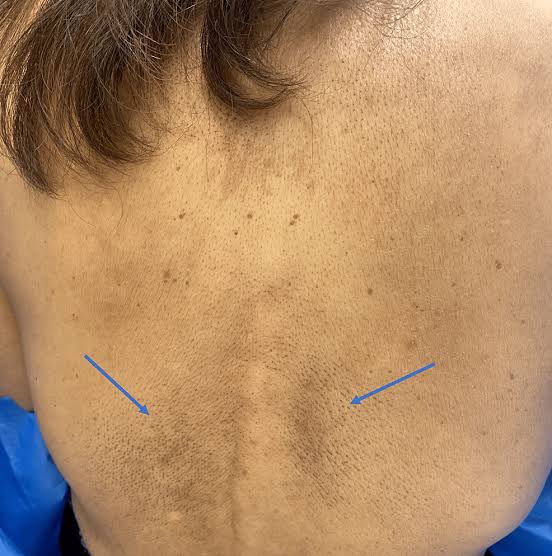 ✨ Stubborn Body Pigmentation Pack