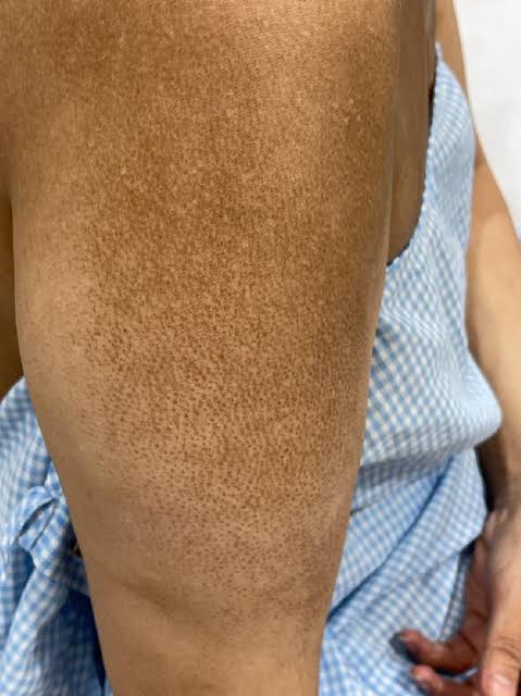 ✨ Stubborn Body Pigmentation Pack